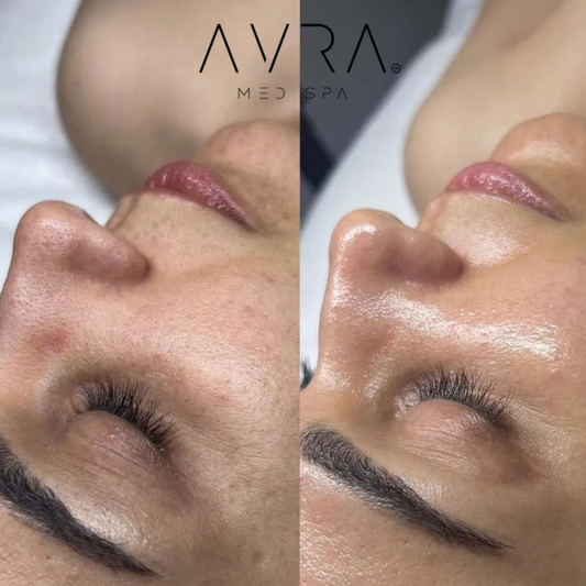 AVRA Signature Hydrafacial